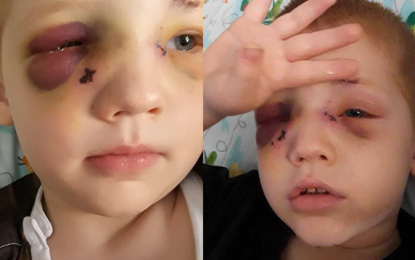 Un garçon de 3 ans est en soins intensifs après une attaque canine à Clearwater